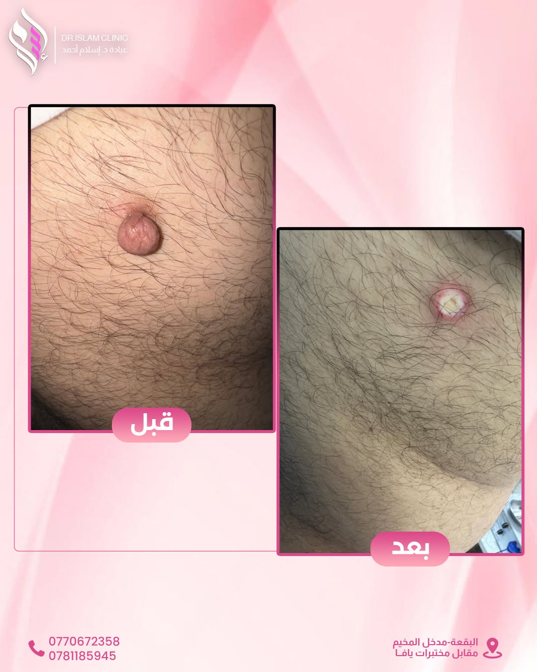 قبل وبعد 6
